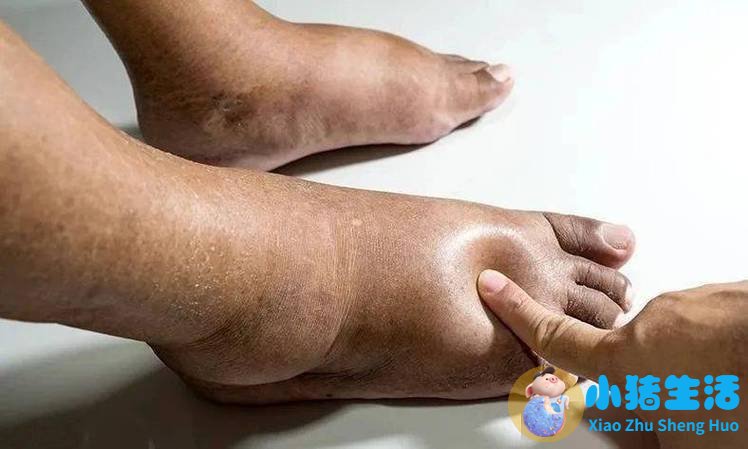 维生素可以溶解痛风石