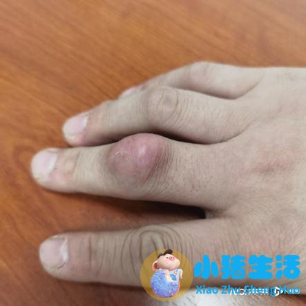 维生素可以溶解痛风石